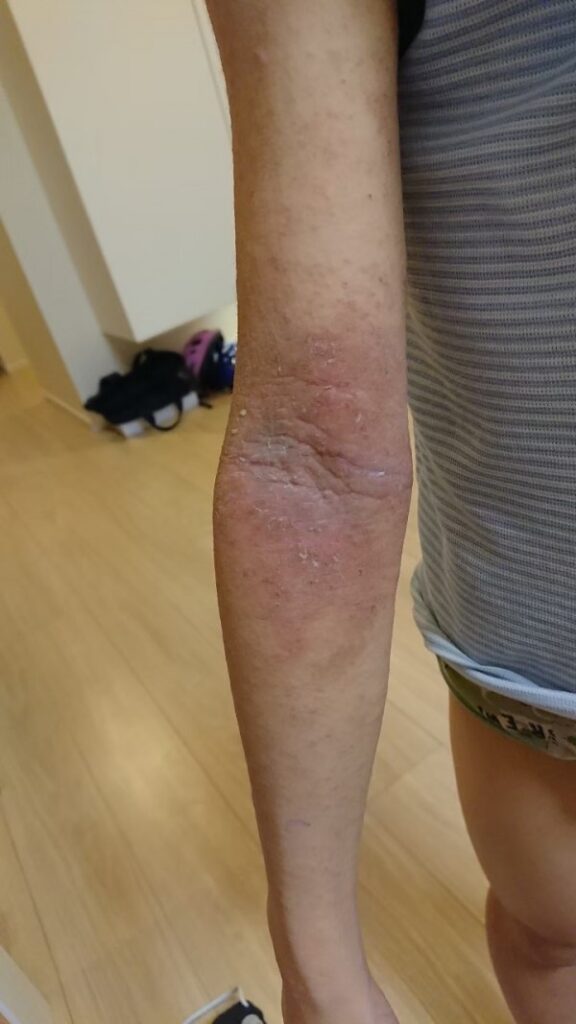 【体験談】アトピーと喘息の息子さんに起きた変化とは？ 画像03
