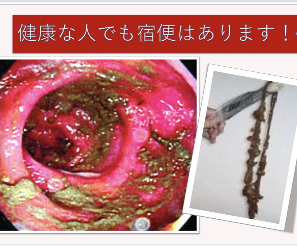 健康な人でも宿便はあります！