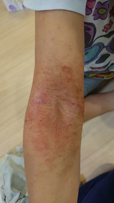 【体験談】アトピーと喘息の息子さんに起きた変化とは？ 画像01